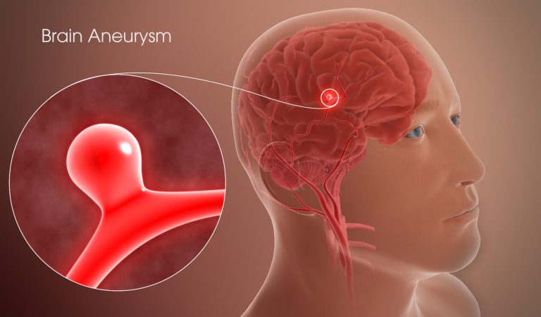 Aneurysm: Signs You Shouldn’t Ignore